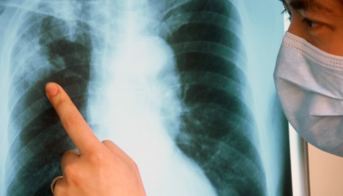 туберкулез